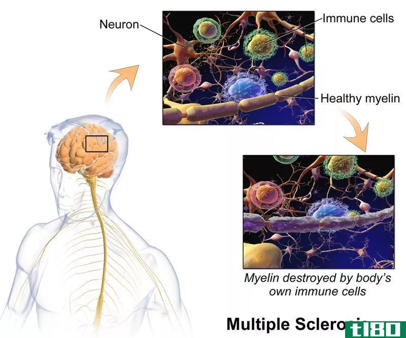 多发性硬化(multiple sclerosis)和系统性硬化(systemic sclerosis)的区别