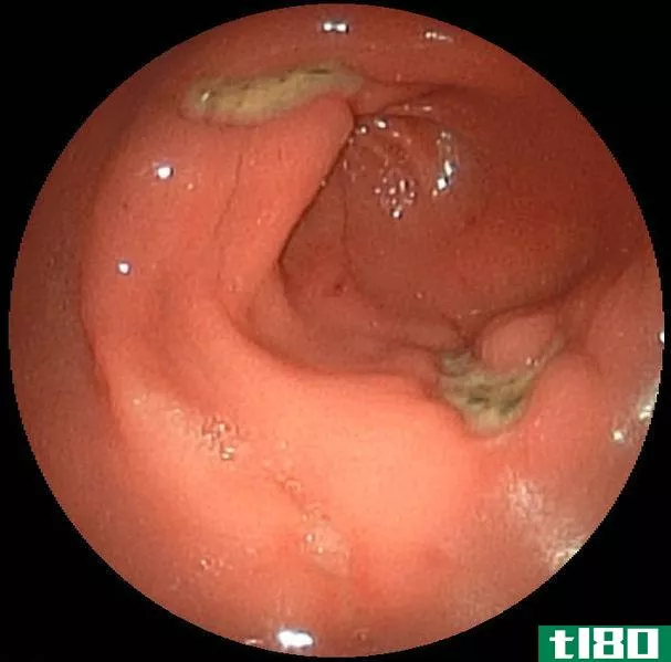 胃炎(gastritis)和十二指肠溃疡(duodenal ulcer)的区别