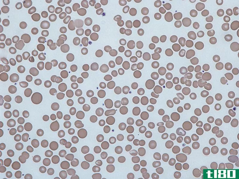 不等红细胞(anisocytosis)和粒细胞增多症(poikilocytosis)的区别