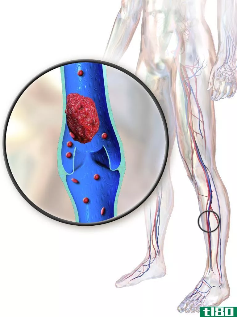 深静脉血栓形成(deep vein thrombosis)和静脉曲张(varicose veins)的区别