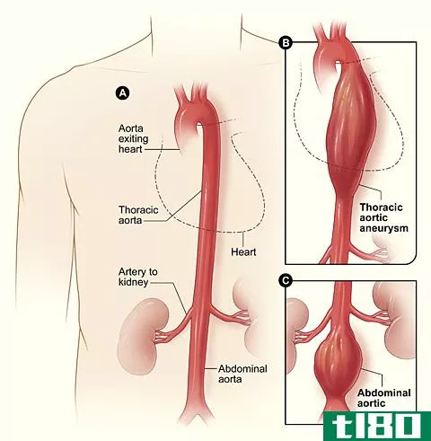 动脉瘤(aneury**)和血凝块(blood clot)的区别