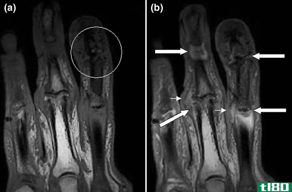纤维肌痛(fibromyalgia)和银屑病性关节炎(psoriatic arthritis)的区别