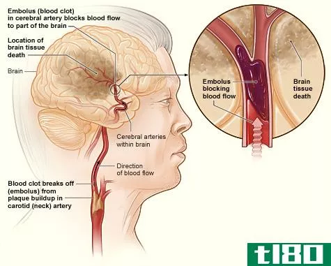 缺血性(ischemic)和出血性中风(hemorrhagic stroke)的区别
