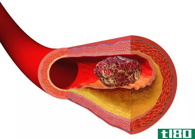 血凝块(blood clot)和组织(tissue)的区别