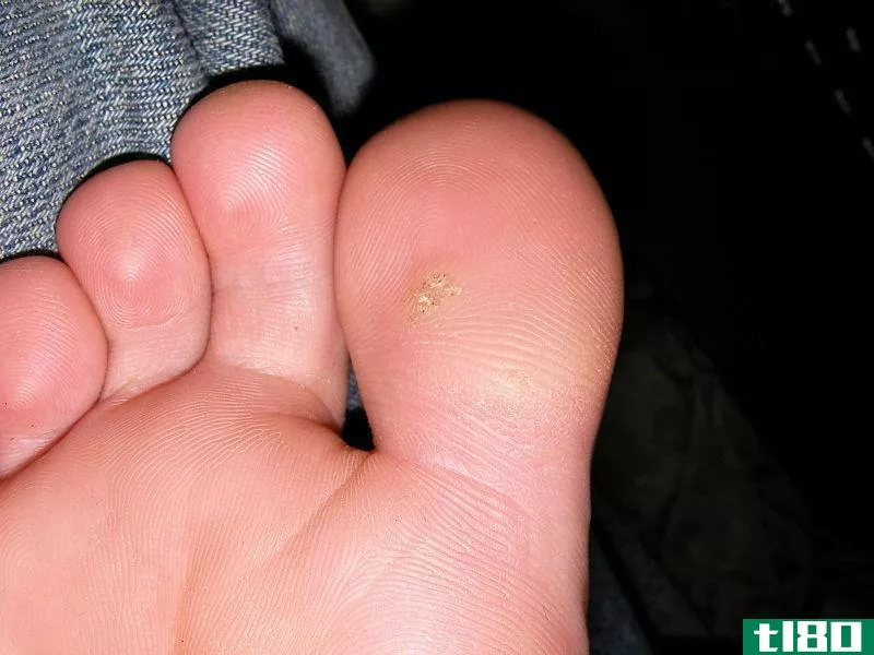 足底疣(plantar wart)和常见疣(common wart)的区别