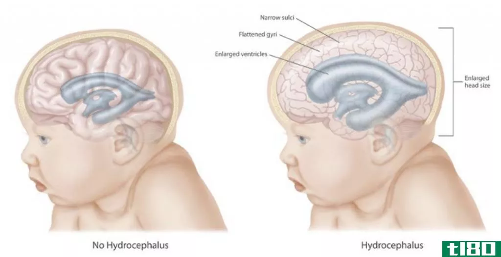 脑水肿(cerebral edema)和脑积水(hydrocephalus)的区别