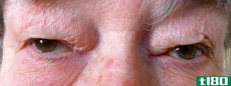 眼睑松弛症(blepharochalasis)和皮肤松弛症(dermatochalasis)的区别