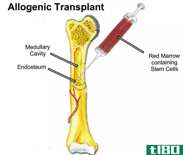 自体(autologous)和异基因干细胞移植(allogeneic stem cell transplant)的区别