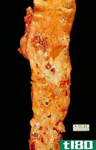 冠状动脉疾病(coronary artery disease)和动脉粥样硬化(atherosclerosis)的区别