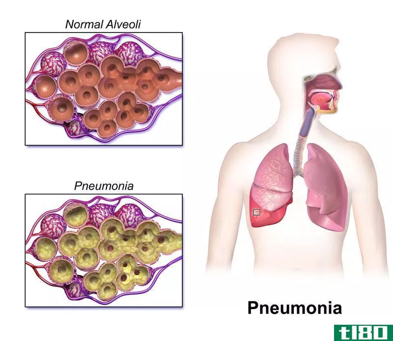 胸腔积液(pleural effusion)和肺炎(pneumonia)的区别