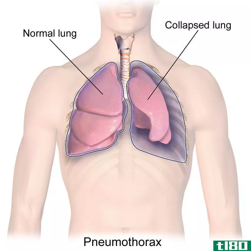 肺不张(atelectasis)和气胸(pneumothorax)的区别