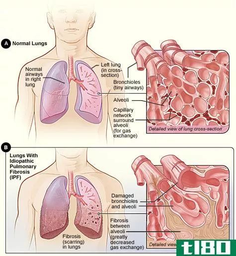 囊性纤维化(cystic fibrosis)和肺纤维化(pulmonary fibrosis)的区别