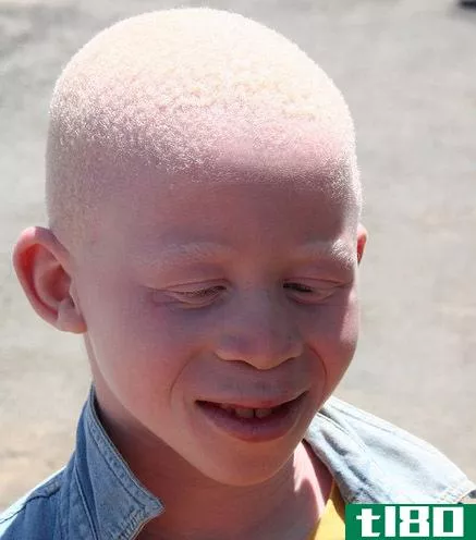 白化病(albini** melani**)和白化(leuci**)的区别