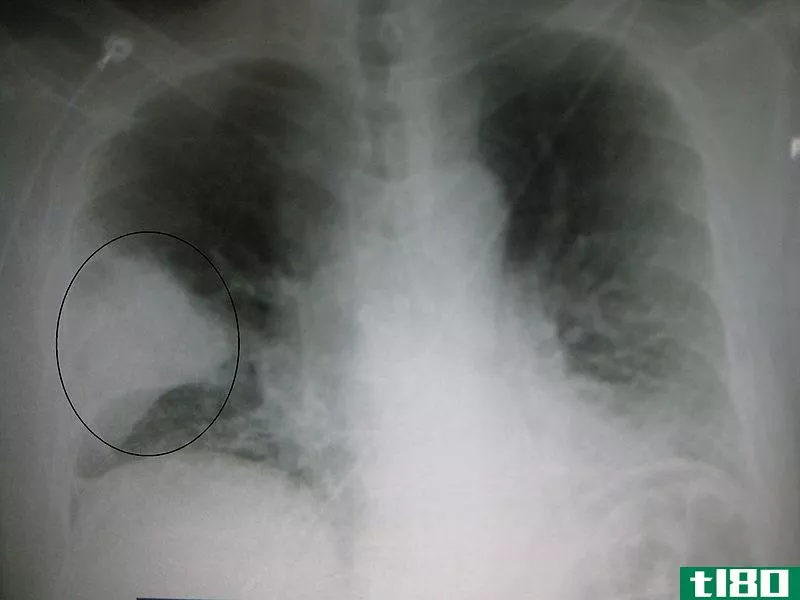 大叶性肺炎(lobar pneumonia)和支气管肺炎(bronchopneumonia)的区别