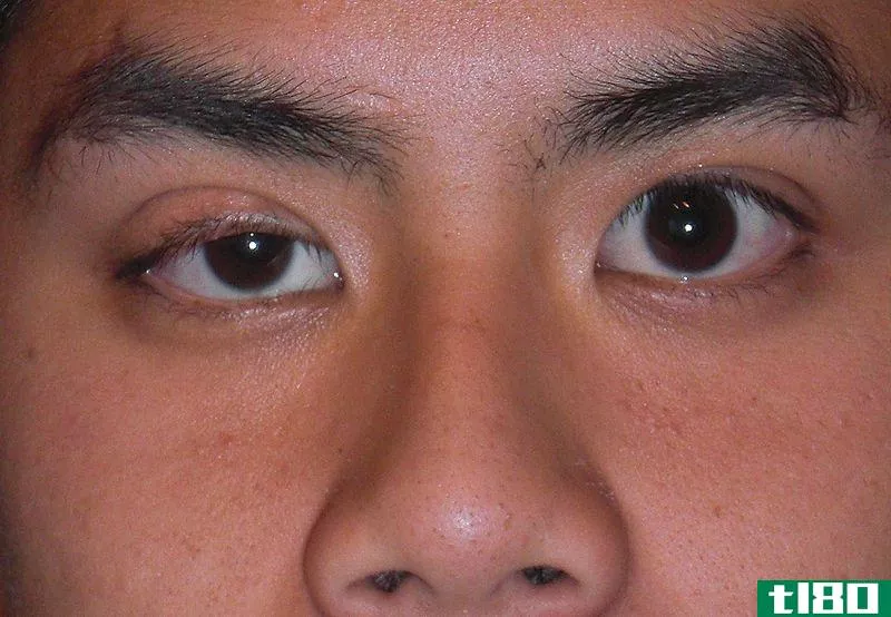 上睑下垂(ptosis)和眼睑成形术(blepharoplasty)的区别