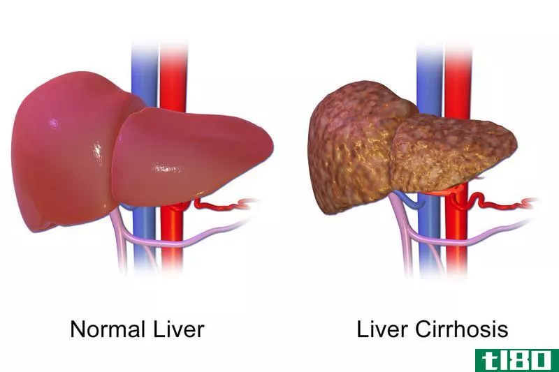 肝硬化(liver cirrhosis)和肝癌(liver cancer)的区别
