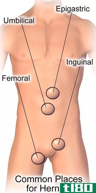 如何辨别腹股沟劳损(how to tell the  groin strain)和疝(hernia)的区别