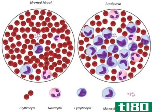 再生障碍性贫血(aplastic anemia)和白血病(leukemia)的区别