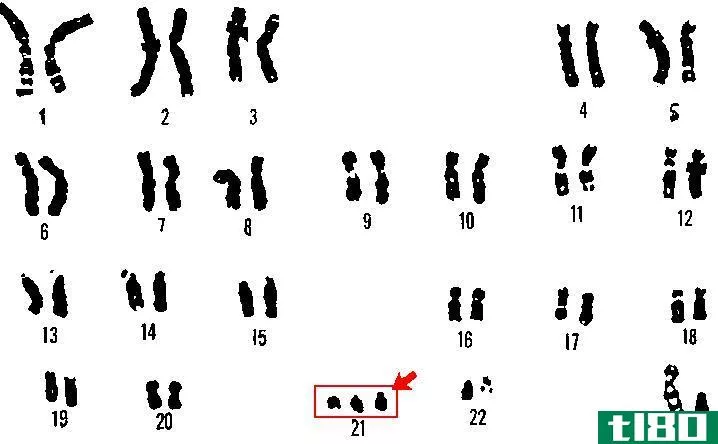单体(monosomy)和三体(trisomy)的区别