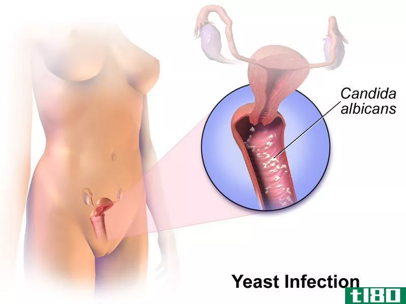 酵母感染(yeast infection)和淋病(gonorrhea)的区别