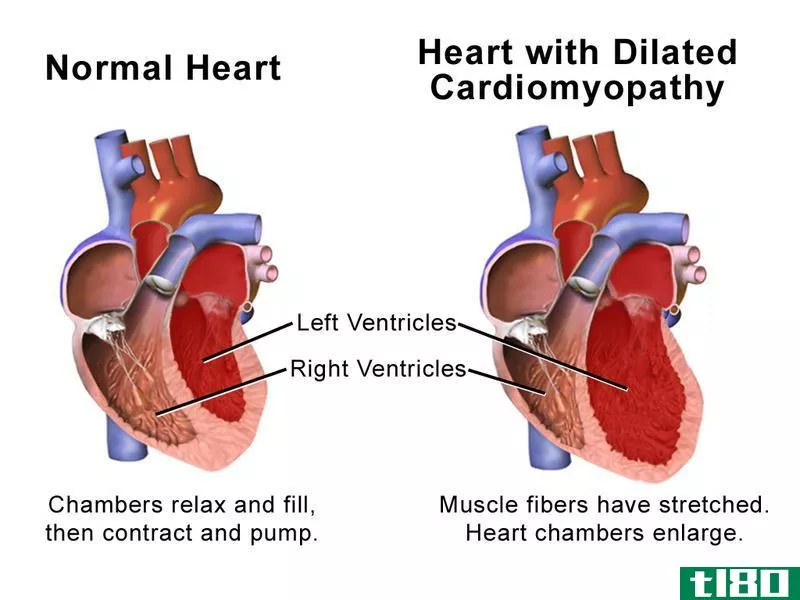 心脏肥大(cardiomegaly)和心肌病(cardiomyopathy)的区别