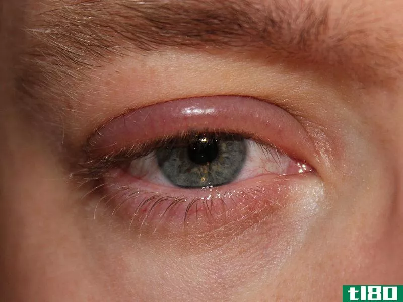 眼睑炎(blepharitis)和斯泰尔(stye)的区别