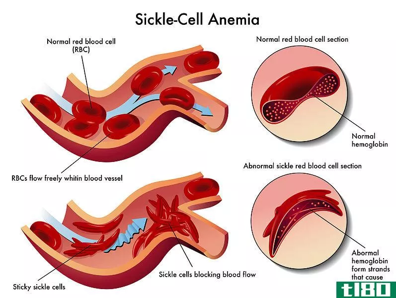 镰状细胞性贫血(sickle cell anemia)和地中海贫血(thalassemia)的区别