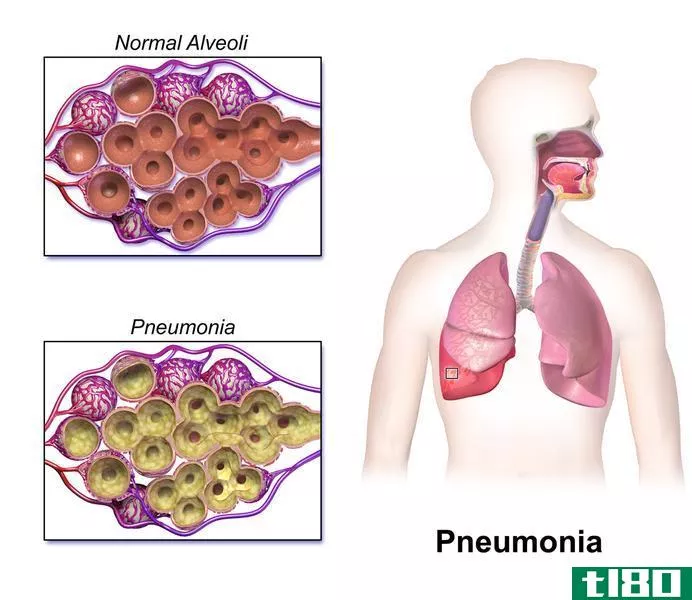 肺炎(pneumonia)和肺炎(pneumonitis)的区别
