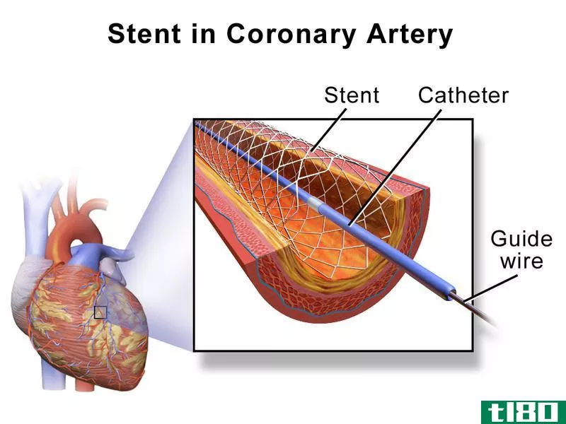血管成形术(angioplasty)和支架(stent)的区别