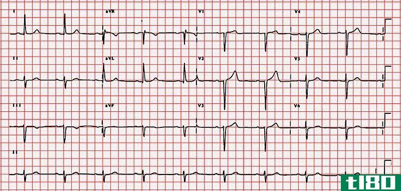 第一和第二(1st 2nd)和三度心脏传导阻滞(3rd degree heart block)的区别