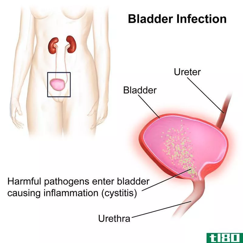 uti公司(uti)和膀胱感染(bladder infection)的区别