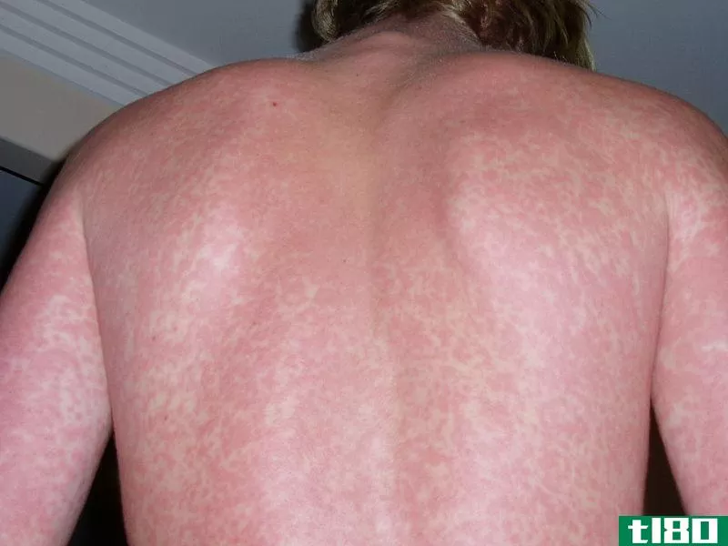 蜂箱(hives)和皮疹(rash)的区别