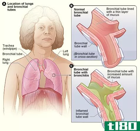 支气管炎(bronchitis)和支气管扩张(bronchiectasis)的区别