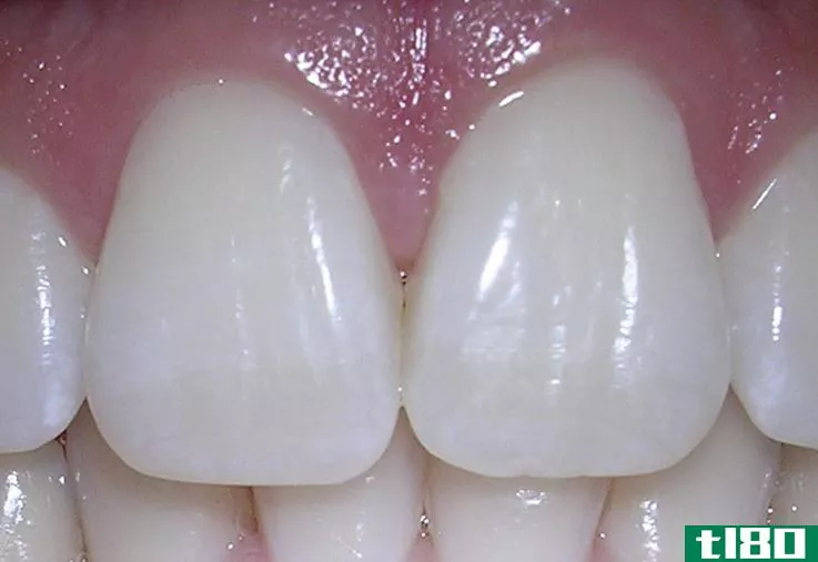 上颌中央(maxillary central)和侧切牙(lateral incisor)的区别