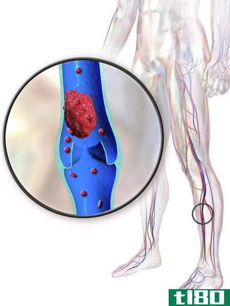 腿抽筋(leg cramp)和血凝块(blood clot)的区别
