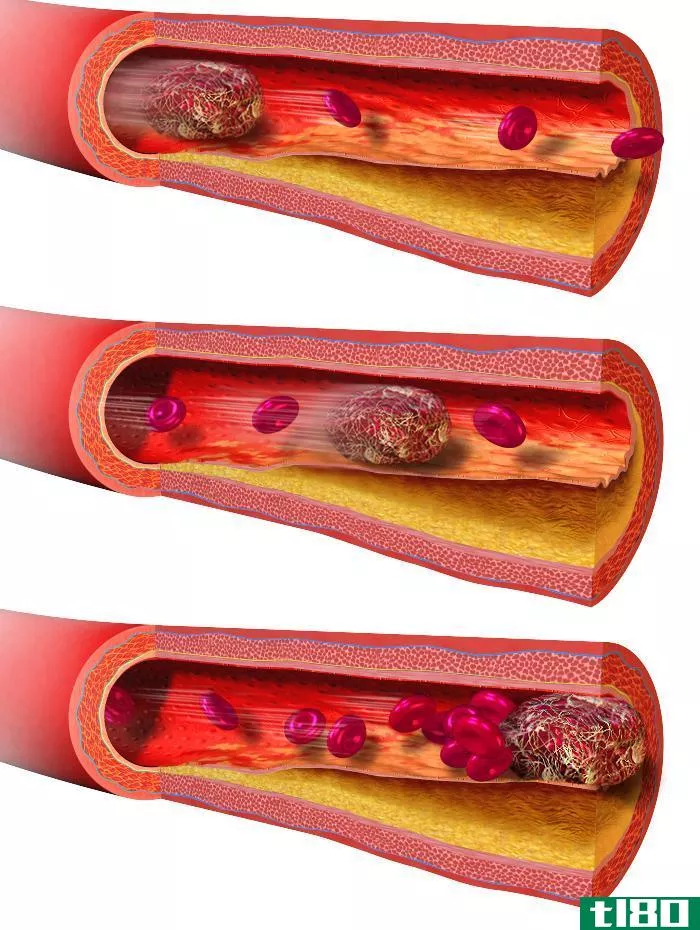 血栓(thrombus)和栓子(embolus)的区别