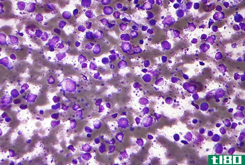 b细胞(b cell)和t细胞淋巴瘤(t cell lymphoma)的区别