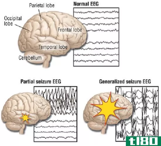 扣押(seizure)和癫痫(epilepsy)的区别