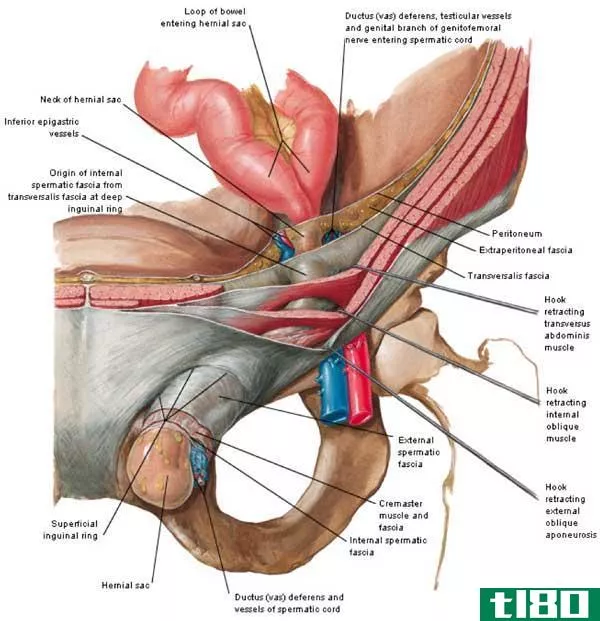 直接的(direct)和腹股沟斜疝(indirect inguinal hernia)的区别