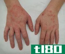 湿疹(eczema)和蜂箱(hives)的区别
