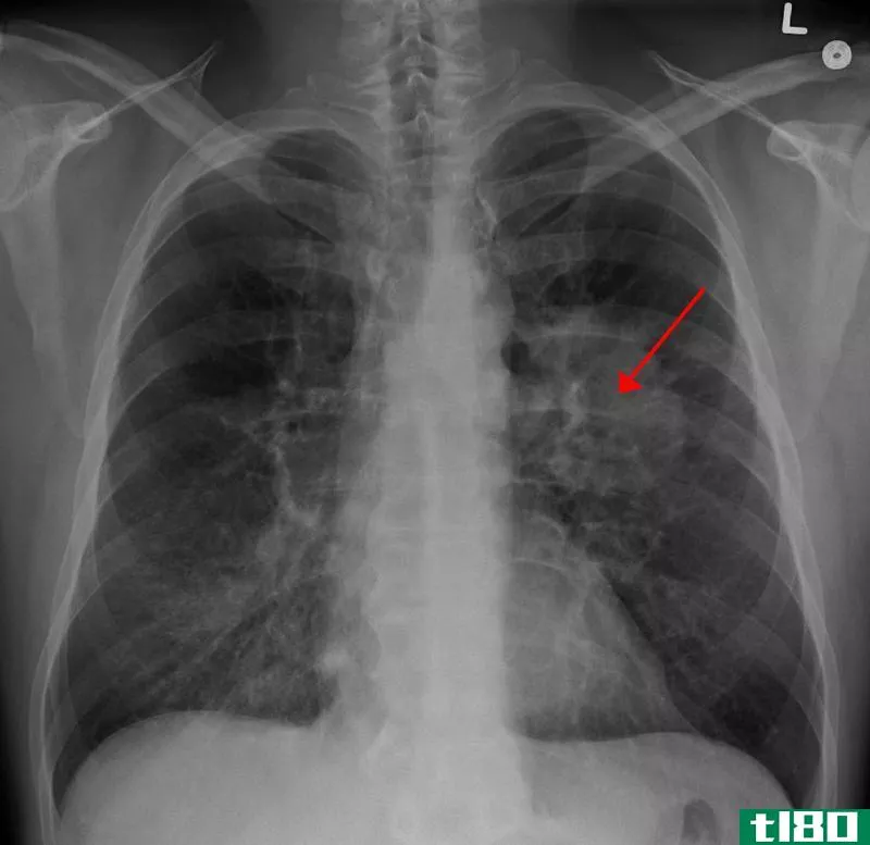肺癌(lung cancer)和肺结核(tuberculosis)的区别