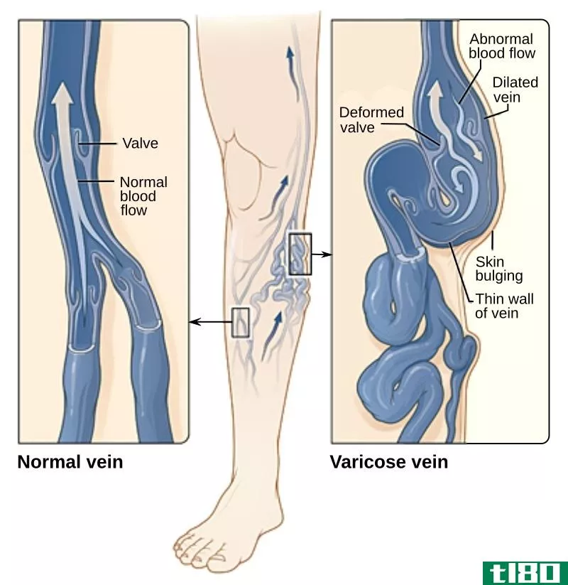 动脉(arterial)和静脉性溃疡(venous ulcers)的区别
