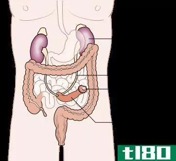 肾造口术(nephrostomy)和尿道造口术(urostomy)的区别