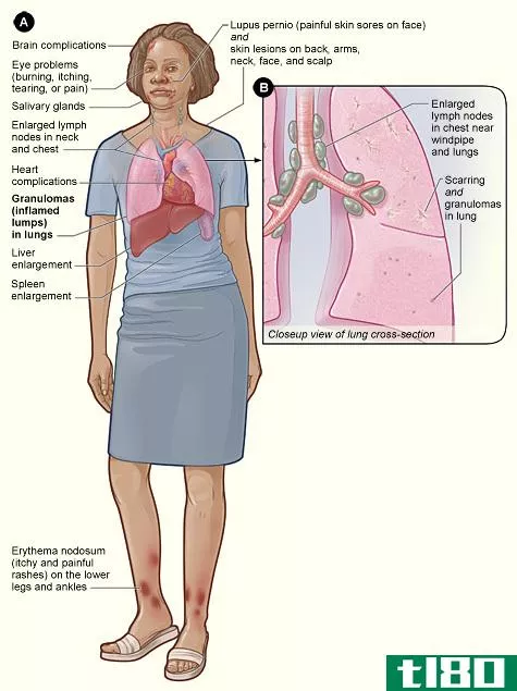 结节病(sarcoidosis)和肺结核(tuberculosis)的区别