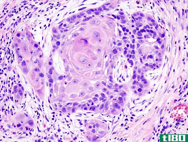 基底细胞癌(basal cell carcinoma)和鳞状细胞癌(squamous cell carcinoma)的区别