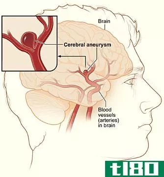 动脉瘤(aneury**)和出血(hemorrhage)的区别