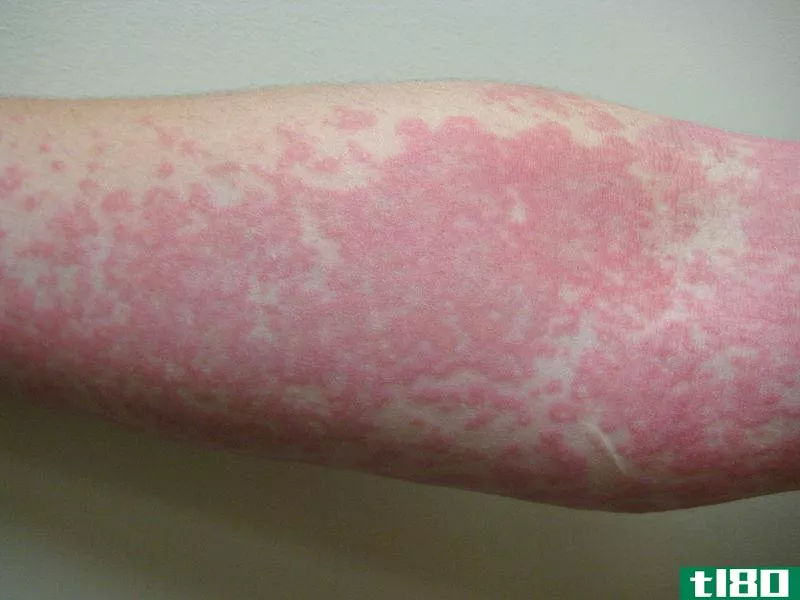 湿疹(eczema)和蜂箱(hives)的区别