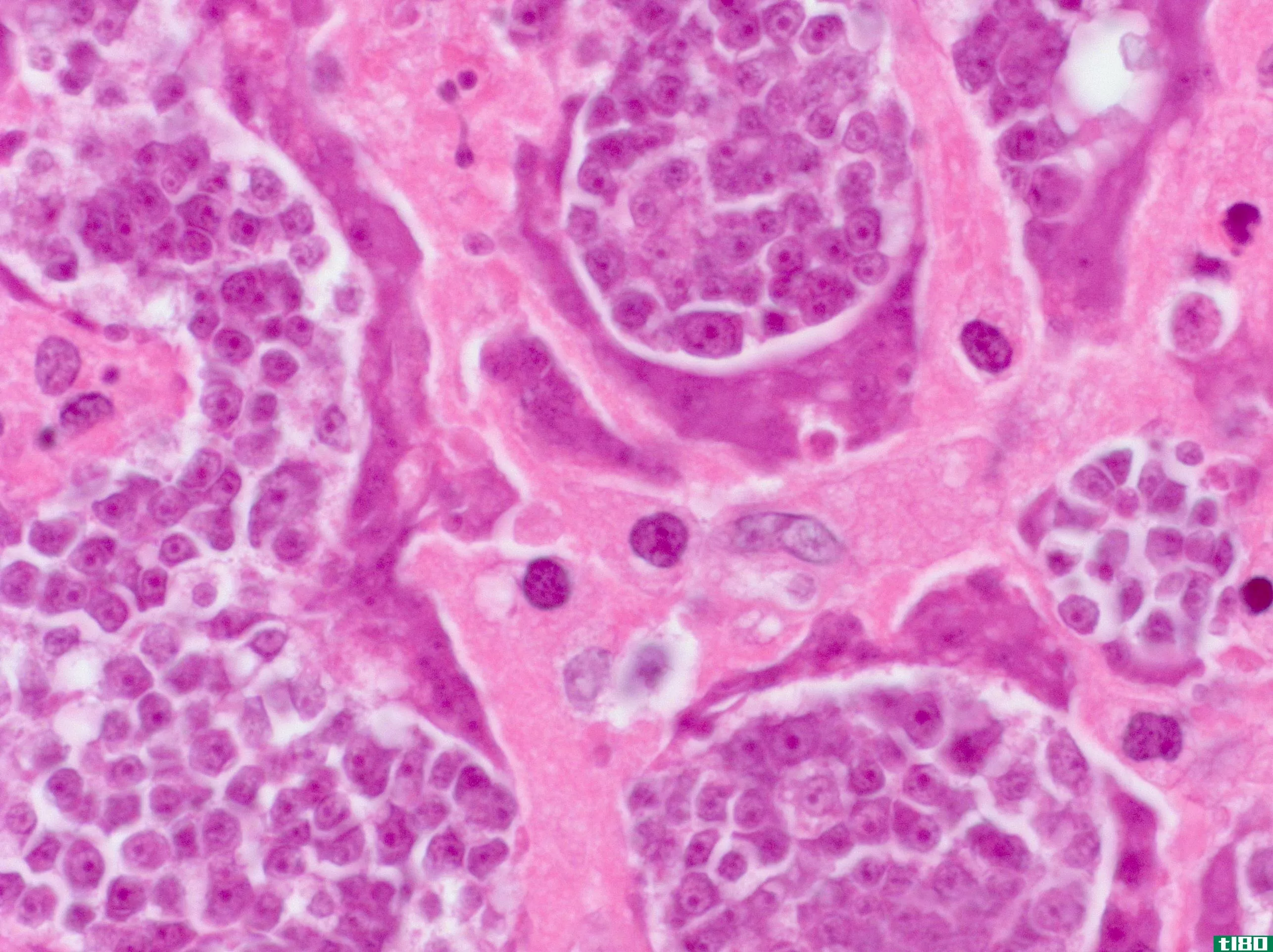 来自绦虫的癌细胞在艾滋病患者体内形成肿瘤