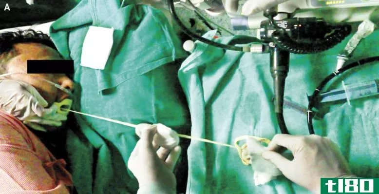 可怕的是：印度医生通过病人的口腔切除了6英尺长的绦虫