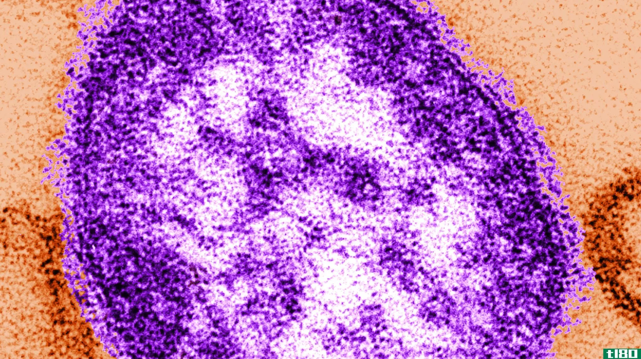 由于抗麻疹药物的作用，明尼苏达州现在的麻疹病例比去年全美国都多